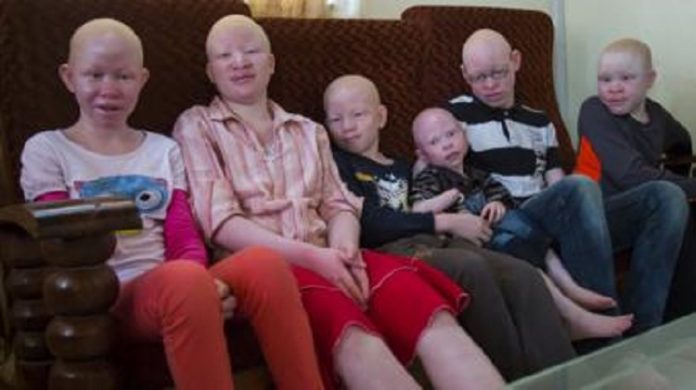 Les-albinos-victimes-de-crimes-rituels-en-Afrique-australe Les albinos victimes de crimes rituels en Afrique australe