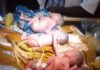Quadruplés nouveau-nés à l’hôpital de Bria, soignés par le personnel médical.